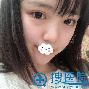 <!--<i data=20240710 data-id=11954></i>-->全切双眼皮+开眼角真实案例恢复效果照片 <!--<i data=20240710 data-id=11954></i>-->全切双眼皮+开眼角真实案例恢复效果照片