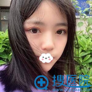 <!--<i data=20240710 data-id=11954></i>-->割双眼皮效果好不好 <!--<i data=20240710 data-id=11954></i>-->割双眼皮效果好不好