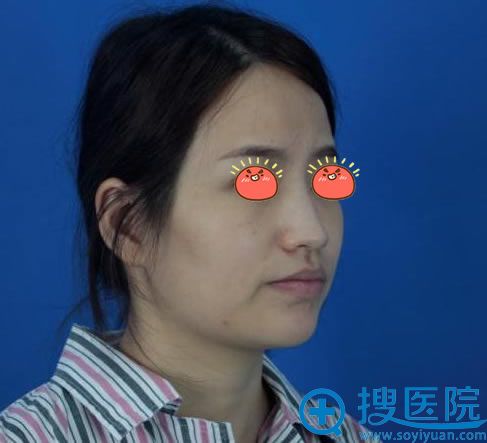 去厦门思明海峡咨询面部线雕尹卫东却让做了自体脂肪面部填充
