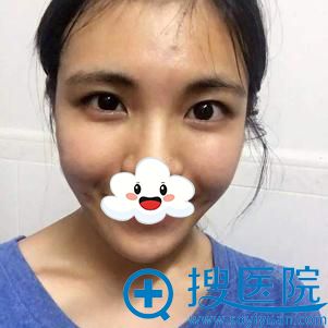 <!--<i data=20240710 data-id=12577></i>-->医疗美容双眼皮+开眼角案例 <!--<i data=20240710 data-id=12577></i>-->医疗美容双眼皮+开眼角案例