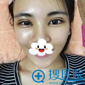 <!--<i data=20240710 data-id=12577></i>-->医疗美容双眼皮+开眼角案例 <!--<i data=20240710 data-id=12577></i>-->医疗美容双眼皮+开眼角案例
