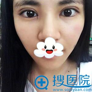 <!--<i data=20240710 data-id=12577></i>-->医疗美容双眼皮+开眼角案例 <!--<i data=20240710 data-id=12577></i>-->医疗美容双眼皮+开眼角案例