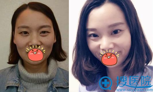 北京杨仁宝院长做双眼皮案例 北京杨仁宝院长做双眼皮案例