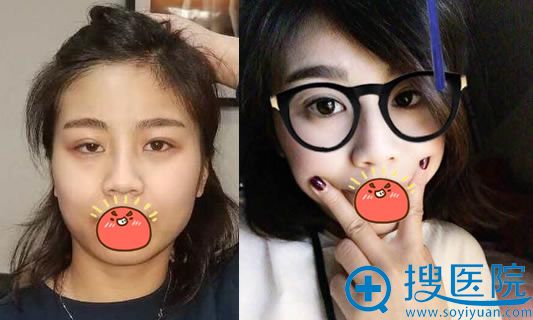 杨仁宝做失败双眼皮修复案例 杨仁宝做失败双眼皮修复案例