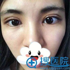 <!--<i data=20240710 data-id=12577></i>-->医疗美容双眼皮+开眼角案例 <!--<i data=20240710 data-id=12577></i>-->医疗美容双眼皮+开眼角案例