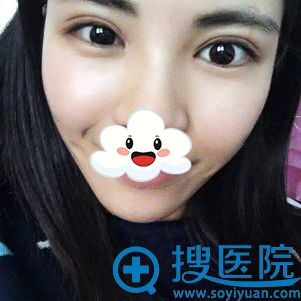 <!--<i data=20240710 data-id=12577></i>-->医疗美容双眼皮+开眼角案例 <!--<i data=20240710 data-id=12577></i>-->医疗美容双眼皮+开眼角案例