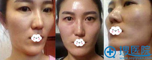 冲着郭杰磨骨效果好才到深圳美莱做填充+祛下颌角颧骨降低