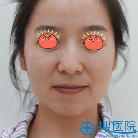 苏州芘丽芙华美和美莱之间我选择华美甘月圆做自体脂肪全脸填充