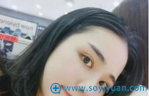 在郑州集美做双眼皮第5天了 在郑州集美做双眼皮第5天了