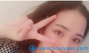 郑州集美刘德辉双眼皮25天自拍 郑州集美刘德辉双眼皮25天自拍