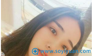 在郑州集美做完双眼皮2个月的我 在郑州集美做完双眼皮2个月的我