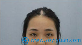 术前单眼皮照片 术前单眼皮照片