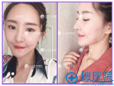 九<!--<i data=20240710 data-id=16293></i>-->美黄小善达拉斯隆鼻术后 九<!--<i data=20240710 data-id=16293></i>-->美黄小善达拉斯隆鼻术后