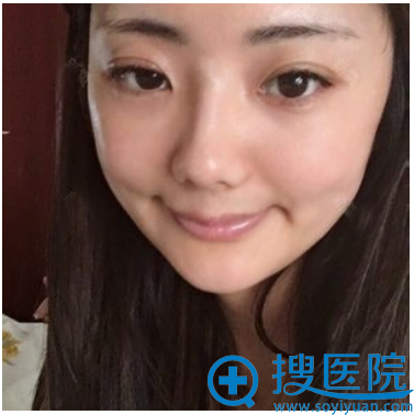 <!--<i data=20240710 data-id=12462></i>-->医院<!--<i data=20240710 data-id=16642></i>-->双眼皮术后7天拆线 <!--<i data=20240710 data-id=12462></i>-->医院<!--<i data=20240710 data-id=16642></i>-->双眼皮术后7天拆线