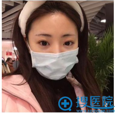 找<!--<i data=20240710 data-id=12462></i>-->医院<!--<i data=20240710 data-id=16642></i>-->做完双眼皮术后半个月了 找<!--<i data=20240710 data-id=12462></i>-->医院<!--<i data=20240710 data-id=16642></i>-->做完双眼皮术后半个月了