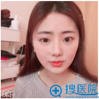 <!--<i data=20240710 data-id=12462></i>-->医院<!--<i data=20240710 data-id=16642></i>-->双眼皮案例术后两个月效果图 <!--<i data=20240710 data-id=12462></i>-->医院<!--<i data=20240710 data-id=16642></i>-->双眼皮案例术后两个月效果图