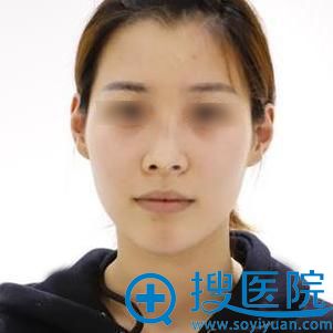 福州爱美尔张胜利院长鼻综合案例分享:翘挺美鼻才更显气质