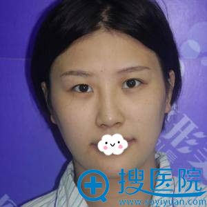 <!--<i data=20240710 data-id=12159></i>-->王全俊韩式翘睫双眼皮真人案例 <!--<i data=20240710 data-id=12159></i>-->王全俊韩式翘睫双眼皮真人案例
