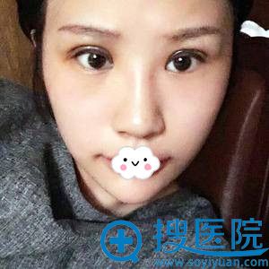 <!--<i data=20240710 data-id=12159></i>-->王全俊割双眼皮怎么样?韩式翘睫双眼皮术后效果 <!--<i data=20240710 data-id=12159></i>-->王全俊割双眼皮怎么样?韩式翘睫双眼皮术后效果