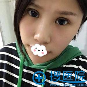 <!--<i data=20240710 data-id=12159></i>-->王全俊韩式翘睫双眼皮恢复过程图 <!--<i data=20240710 data-id=12159></i>-->王全俊韩式翘睫双眼皮恢复过程图