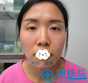 <!--<i data=20240710 data-id=12923></i>-->双眼皮失败修复效果怎么样?罗通贵医生修复案例 <!--<i data=20240710 data-id=12923></i>-->双眼皮失败修复效果怎么样?罗通贵医生修复案例