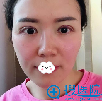 <!--<i data=20240710 data-id=12923></i>-->罗通贵双眼皮失败修复真人案例 <!--<i data=20240710 data-id=12923></i>-->罗通贵双眼皮失败修复真人案例
