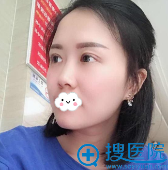<!--<i data=20240710 data-id=12923></i>-->罗通贵双眼皮失败修复术后效果 <!--<i data=20240710 data-id=12923></i>-->罗通贵双眼皮失败修复术后效果