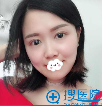 双眼皮失败到<!--<i data=20240710 data-id=12923></i>-->罗通贵处做眼部失败 双眼皮失败到<!--<i data=20240710 data-id=12923></i>-->罗通贵处做眼部失败