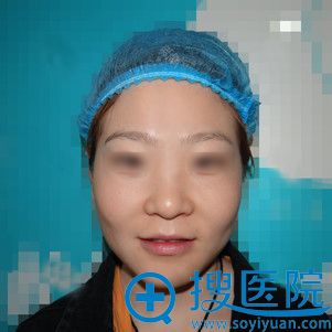 考虑到玻尿酸隆鼻效果不持久所以去郑州悦美做了硅胶隆鼻