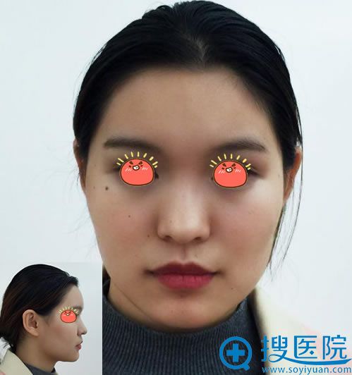 在宜昌伊莱美做隆鼻手术前 在宜昌伊莱美做隆鼻手术前
