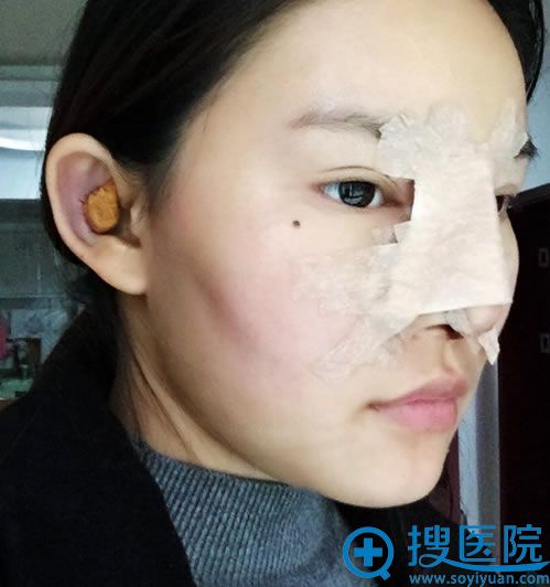 在伊莱美刚做完隆鼻手术图片 在伊莱美刚做完隆鼻手术图片