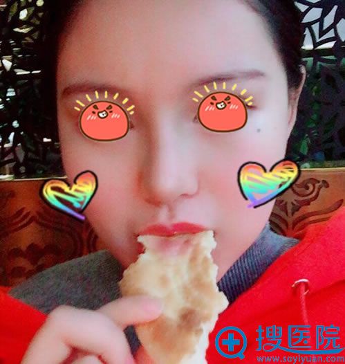 宜昌伊莱美做鼻综合隆鼻3天后 宜昌伊莱美做鼻综合隆鼻3天后
