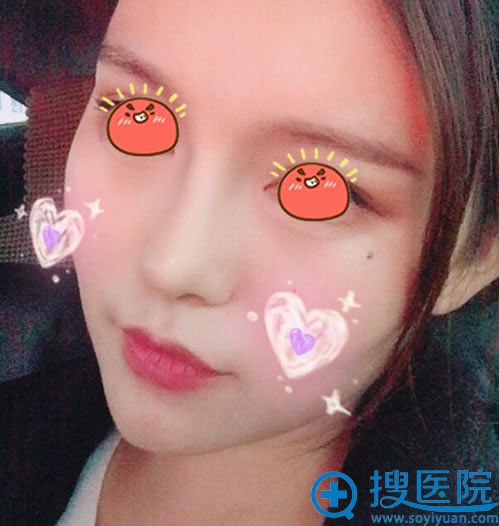选择宜昌伊莱美刘志后隆鼻15天后 选择宜昌伊莱美刘志后隆鼻15天后