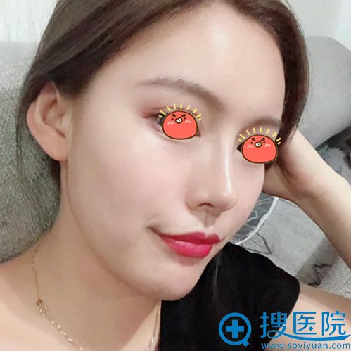 宜昌伊莱美刘志兵隆鼻案例半年效果图 宜昌伊莱美刘志兵隆鼻案例半年效果图
