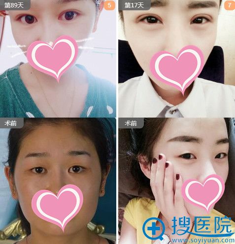 美莱坞整形眼综合+全切双眼皮案例术前术后对比图 美莱坞整形眼综合+全切双眼皮案例术前术后对比图