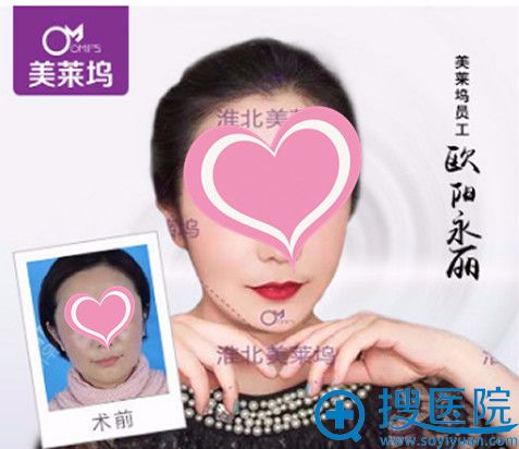 淮北伊美尔整形注射瘦脸除皱瘦脸术前术后对比案例 淮北伊美尔整形注射瘦脸除皱瘦脸术前术后对比案例