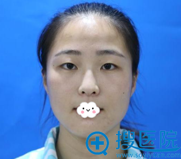 青岛华颜美毛可玮割双眼皮真人案例 青岛华颜美毛可玮割双眼皮真人案例