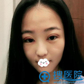 青岛华颜美割双眼皮怎么样?毛可玮真人案例 青岛华颜美割双眼皮怎么样?毛可玮真人案例