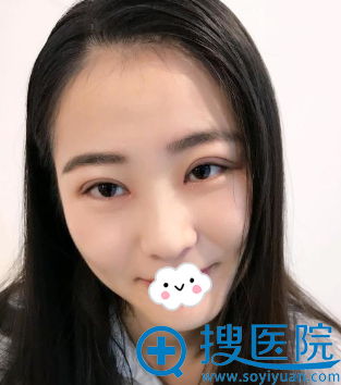 青岛华颜美毛可玮全切双眼皮术后效果怎么样 青岛华颜美毛可玮全切双眼皮术后效果怎么样