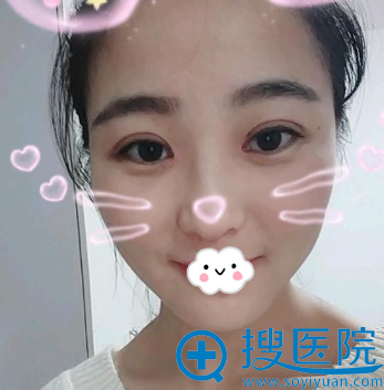 青岛华颜美毛可玮全切双眼皮案例 青岛华颜美毛可玮全切双眼皮案例