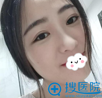 青岛华颜美切开双眼皮术后恢复效果图 青岛华颜美切开双眼皮术后恢复效果图