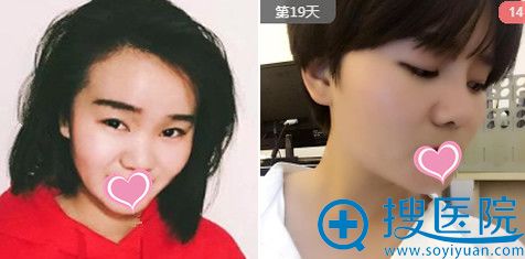 东方美莱坞整形硅胶假体隆鼻案例 东方美莱坞整形硅胶假体隆鼻案例