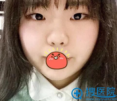 男友送的七夕礼物是武汉美嘉陈庚圣做双眼皮和开眼角手术名额