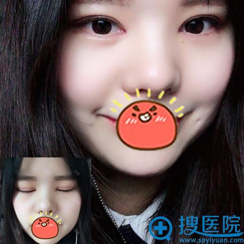 �人����˫��Ƥ7��̺ۻָ����