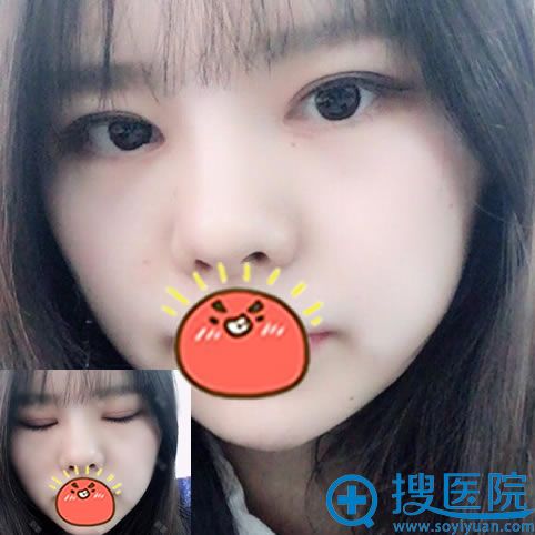 �人����˫��Ƥ�Ϳ��۽ǰ���30��Ч��