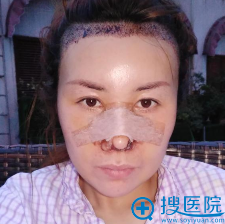 帮忙看一下我找上海华美黄兴勇主任做的发际线种植效果怎么样