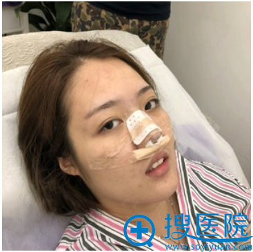 上海美仑整形医院胡晓龙隆鼻术后效果 上海美仑整形医院胡晓龙隆鼻术后效果
