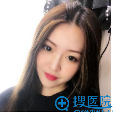 找上海美仑整形医院胡晓龙做的隆鼻子术后一个月效果 找上海美仑整形医院胡晓龙做的隆鼻子术后一个月效果