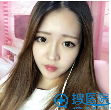 上海美仑整形医院胡晓龙双眼皮隆鼻案例术后图片 上海美仑整形医院胡晓龙双眼皮隆鼻案例术后图片