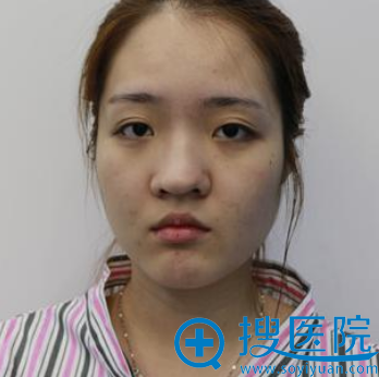 之前找上海美仑整形医院胡晓龙做的双眼皮不错这次又来做了隆鼻